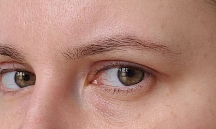 Asymetria po blefaroplastyce - 72838