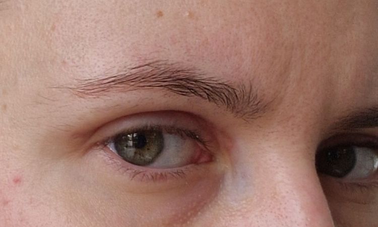 Asymetria po blefaroplastyce - 72839