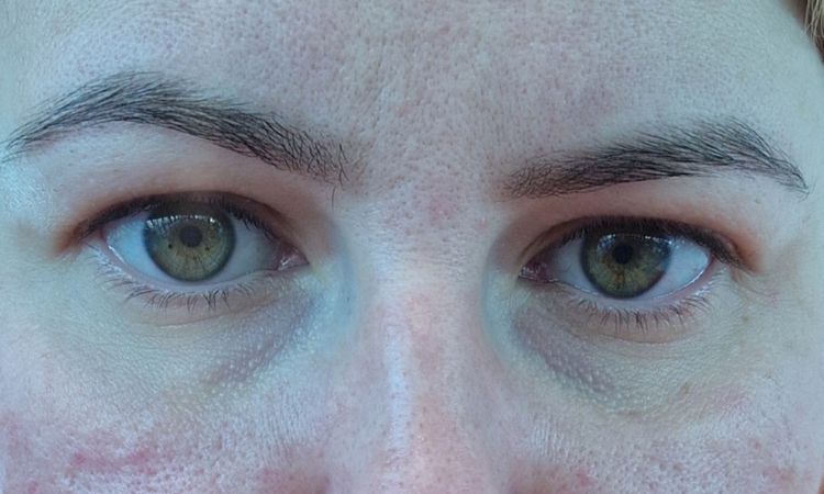 Asymetria po blefaroplastyce - 72840