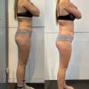 Nieudana liposukcja laserowa