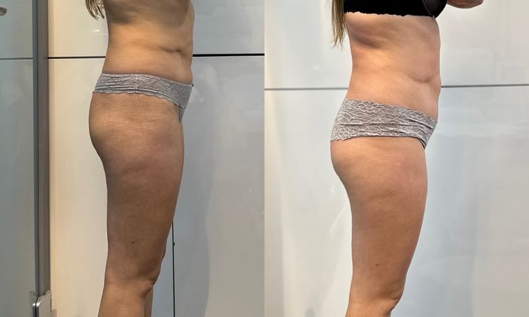 Nieudana liposukcja laserowa - 72948
