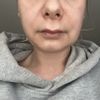 Opuchnięta twarz po hialuronidazie