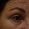 Stymulator tkankowy ( mezoterapia ) pod oczy "podkowy pod oczami" - 73277