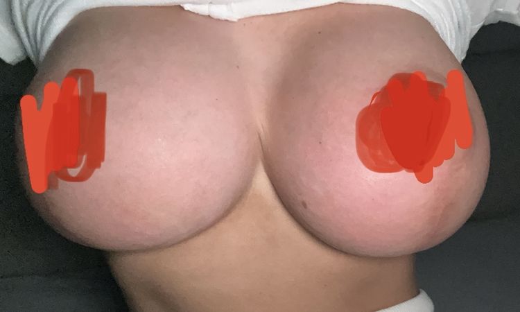 Nadmiar skóry między implantami i symmastia po operacji piersi - 73899