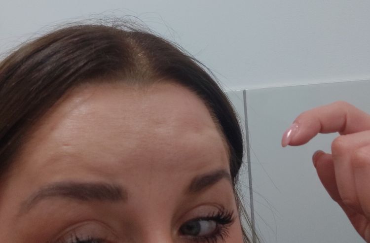 Miał być botox okazało się że podany został Dives BTX