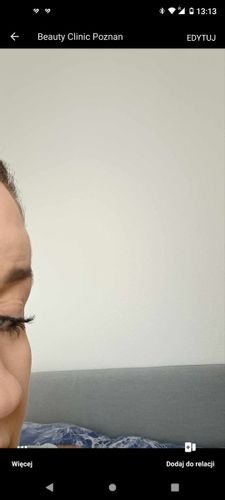 Miał być botox okazało się że podany został Dives BTX
