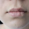 Usunięcie blizny-naczyniaka na ustach