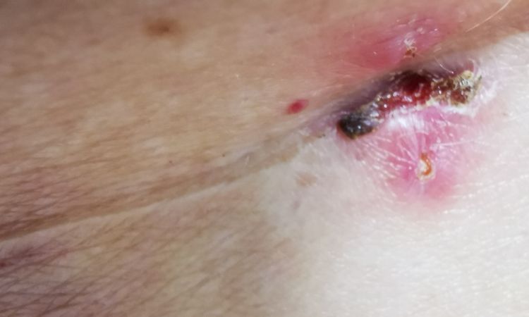 Rozejście rany po laparoskopii - 75006
