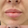 Lip lift brak efektu