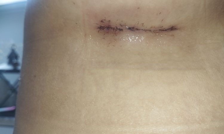 Niepokojące rany po operacji powiększenia biustu - 75879