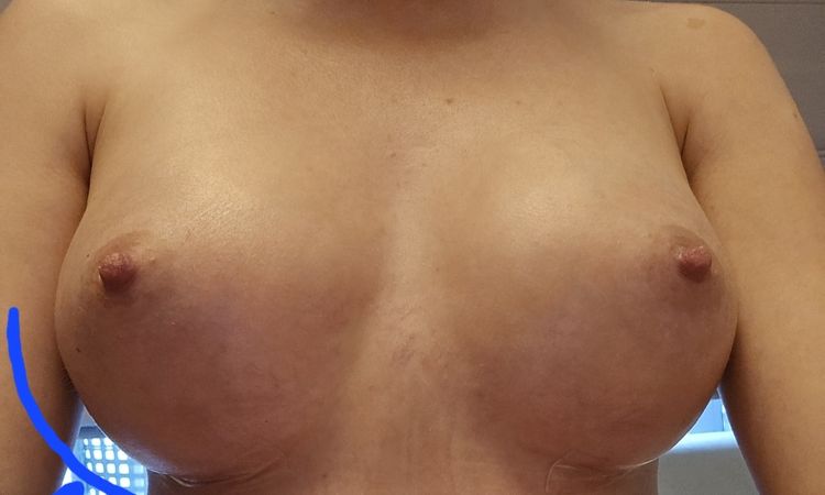 Nagłe wypłaszczenie piersi po 2,5 miesiąca od operacji - 78017