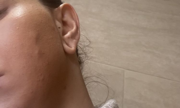 Usunięcie nici PDO tylko po jednej stornie - 78165