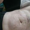 Plastyka brzucha problemy