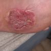 Fibromatoza, przeszczep