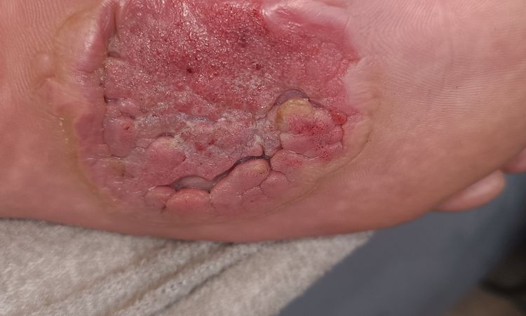 Fibromatoza, przeszczep - 78594