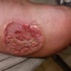 Fibromatoza, przeszczep