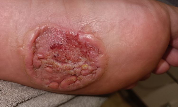 Fibromatoza, przeszczep - 78595