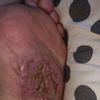 Fibromatoza, przeszczep
