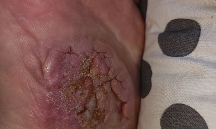 Fibromatoza, przeszczep - 78596