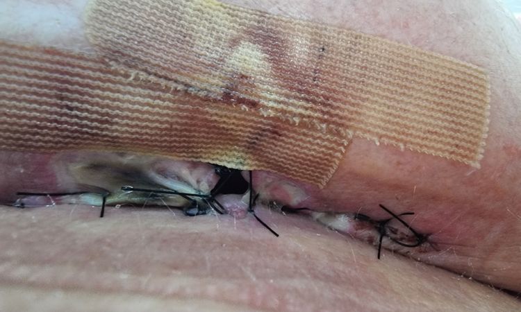 Długo gojąca się rana pod biustem. - 78765
