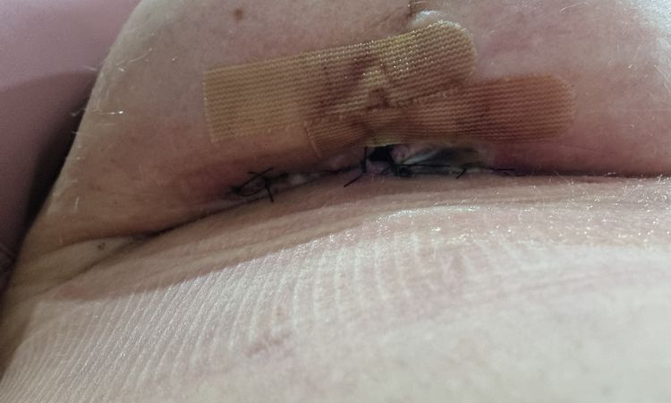 Długo gojąca się rana pod biustem. - 78767