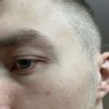 ślad po usuwaniu znamion barwnikowych laserem