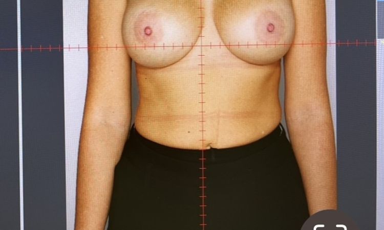 Pęknięcie implantu motiva piersi po 2 latach - 78960