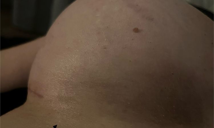 Asymetria po operacji ? - 79275
