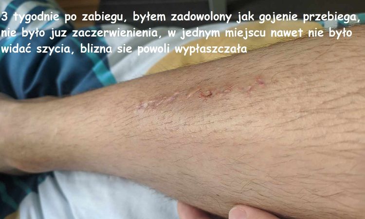 Plastyka blizny po poparzeniu - 79305