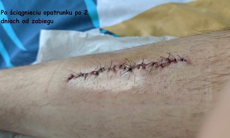 Plastyka blizny po poparzeniu - 79309