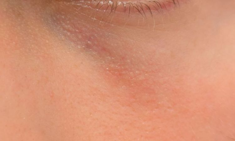 Rumień skóry po zamykaniu naczynek laserem - 79777