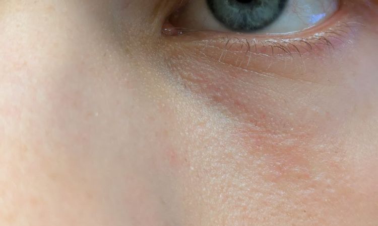 Rumień skóry po zamykaniu naczynek laserem - 79778