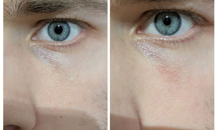 Rumień skóry po zamykaniu naczynek laserem - 79779