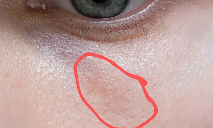 Rumień skóry po zamykaniu naczynek laserem - 79780