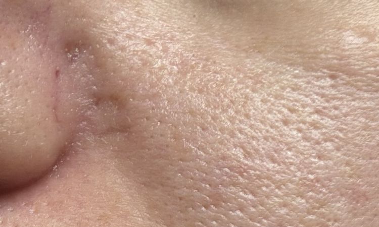 Blizny po laserze naczyniowym - 79806