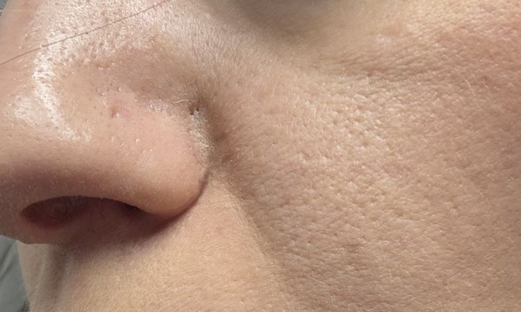 Blizny po laserze naczyniowym - 79807