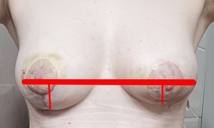 Deformacja piersi po krwiaku przy lifcie - 79832