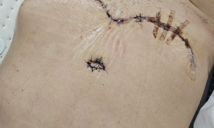 Uwypuklenia nad blizną po plastyce brzucha - 79960