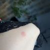 Rumień po laserze frakcyjnym