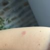 Rumień po laserze frakcyjnym