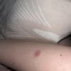 Rumień po laserze frakcyjnym