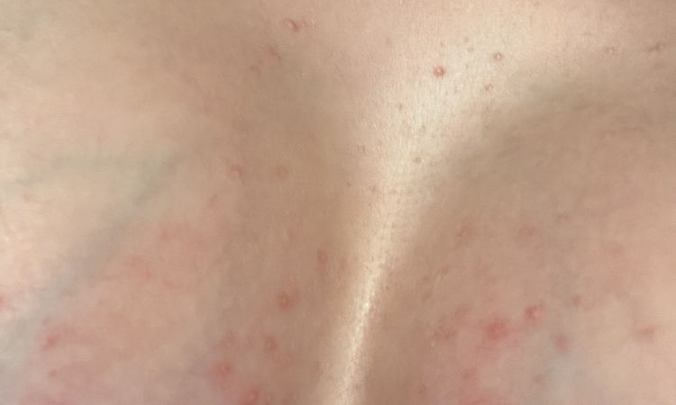 Powiększenie piersi pryszcze ropne - 80720