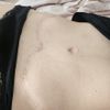 Nadmiar tkanki tłuszczowej po plastyce brzucha