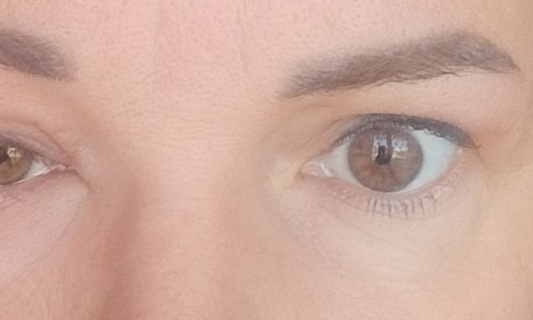 opuchlizna oka 2 msc po blefaroplastyce - 81287