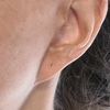Korekta tzw. pixie ears