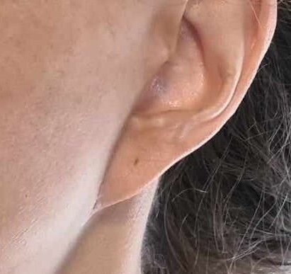 Korekta tzw. pixie ears - 81771