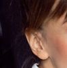 Korekta tzw. pixie ears