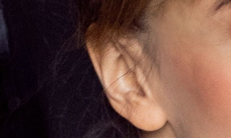 Korekta tzw. pixie ears - 81772