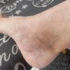 Skleroterapia i jej powikłania