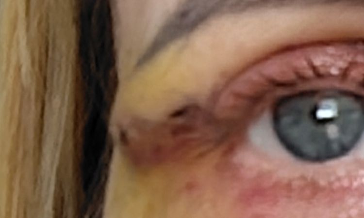 Uwypuklenie na końcu szycia po blefaroplastyce - 82013